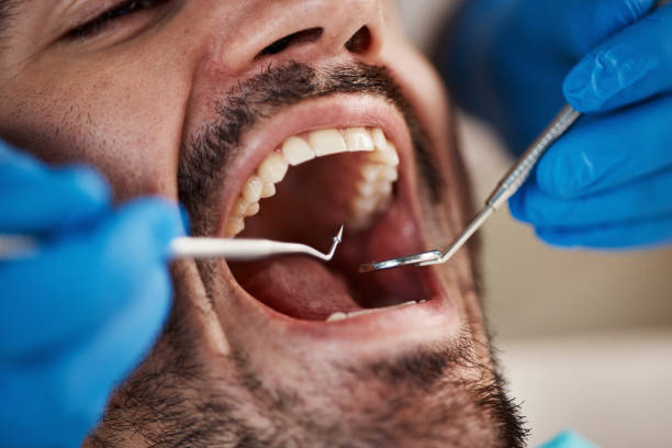 Best Emergency Wisdom Teeth Removal in Astia, OR